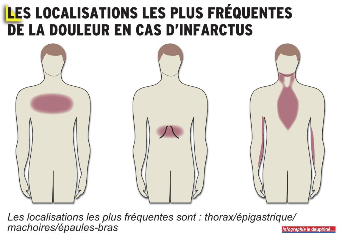 douleurs d'infractus